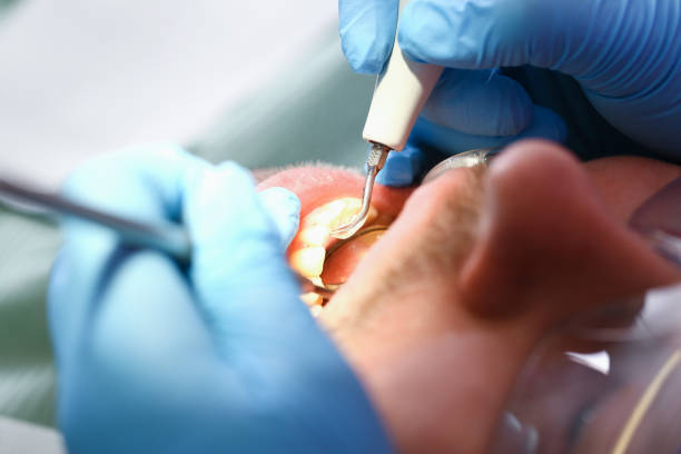 Best Emergency Dental Care for Abscessed Tooth in Boyes Hot Springs, CA