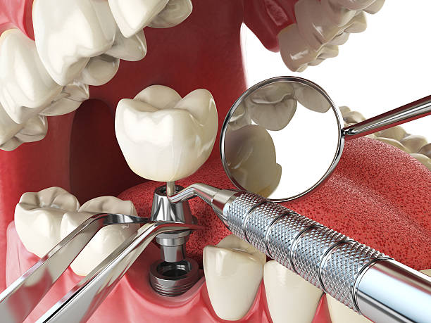 Best Emergency Dental Care for Abscessed Tooth in Boyes Hot Springs, CA